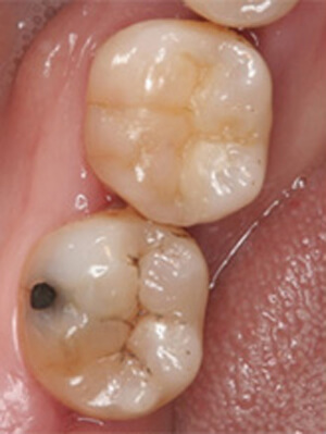 奥歯の詰め物と虫歯