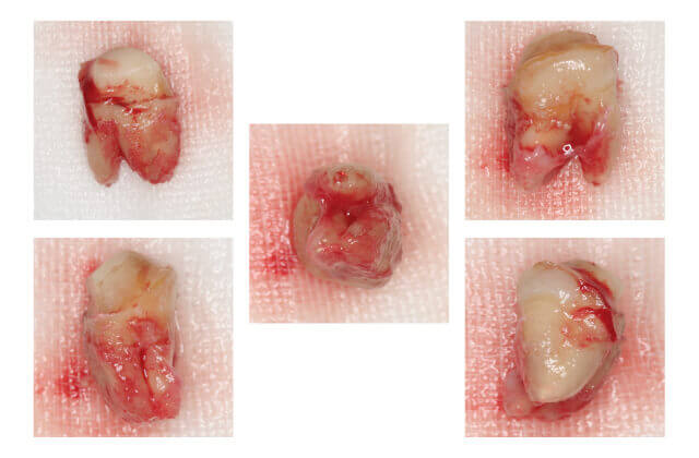 抜いた患歯の状態を調べ病巣部のみを切除します
