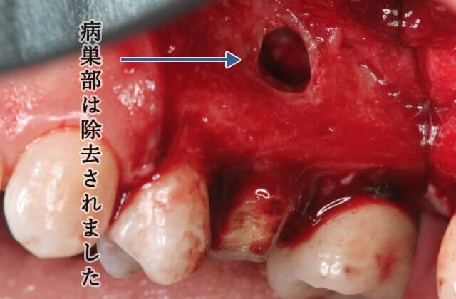 歯肉の下にある病巣部を除去しています