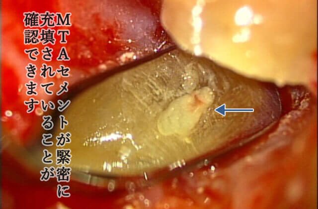 病巣部を除去した後、顕微鏡下でMTAセメントによる緊密な封鎖を確認