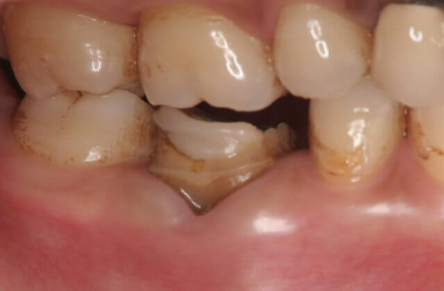 歯根破折に対する保存治療症例