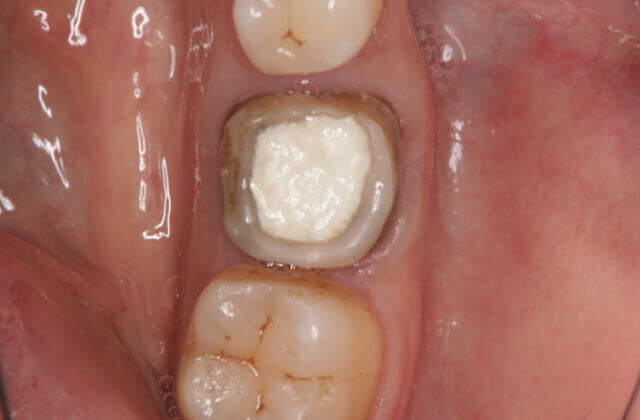 歯根破折に対する保存治療症例