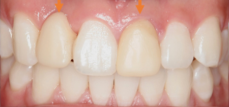 前歯部における審美修復 術前