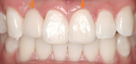 前歯部における審美修復 術後