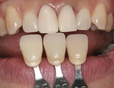 周囲の歯と調和する歯の形態・色