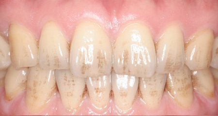  歯に付着したステイン除去とホワイトニング